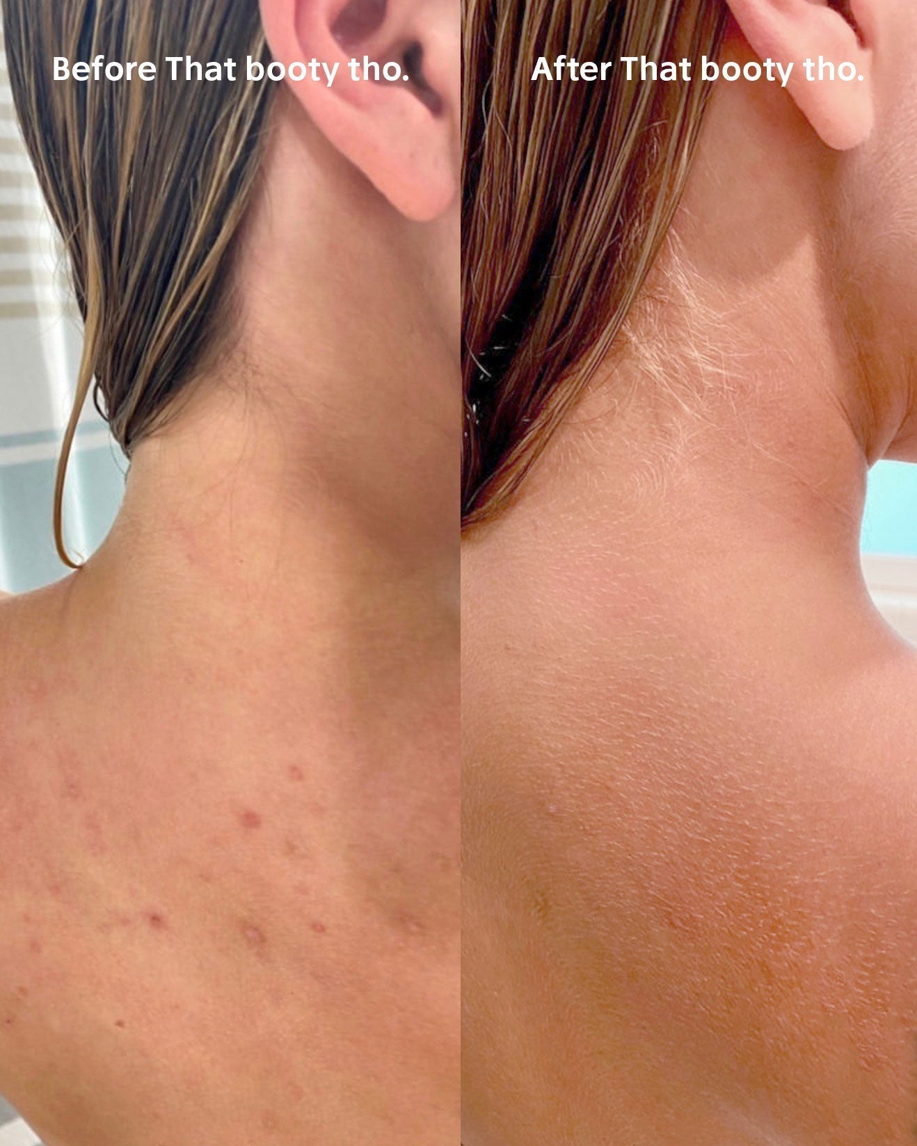 Body Acne Scrub - 90 Day