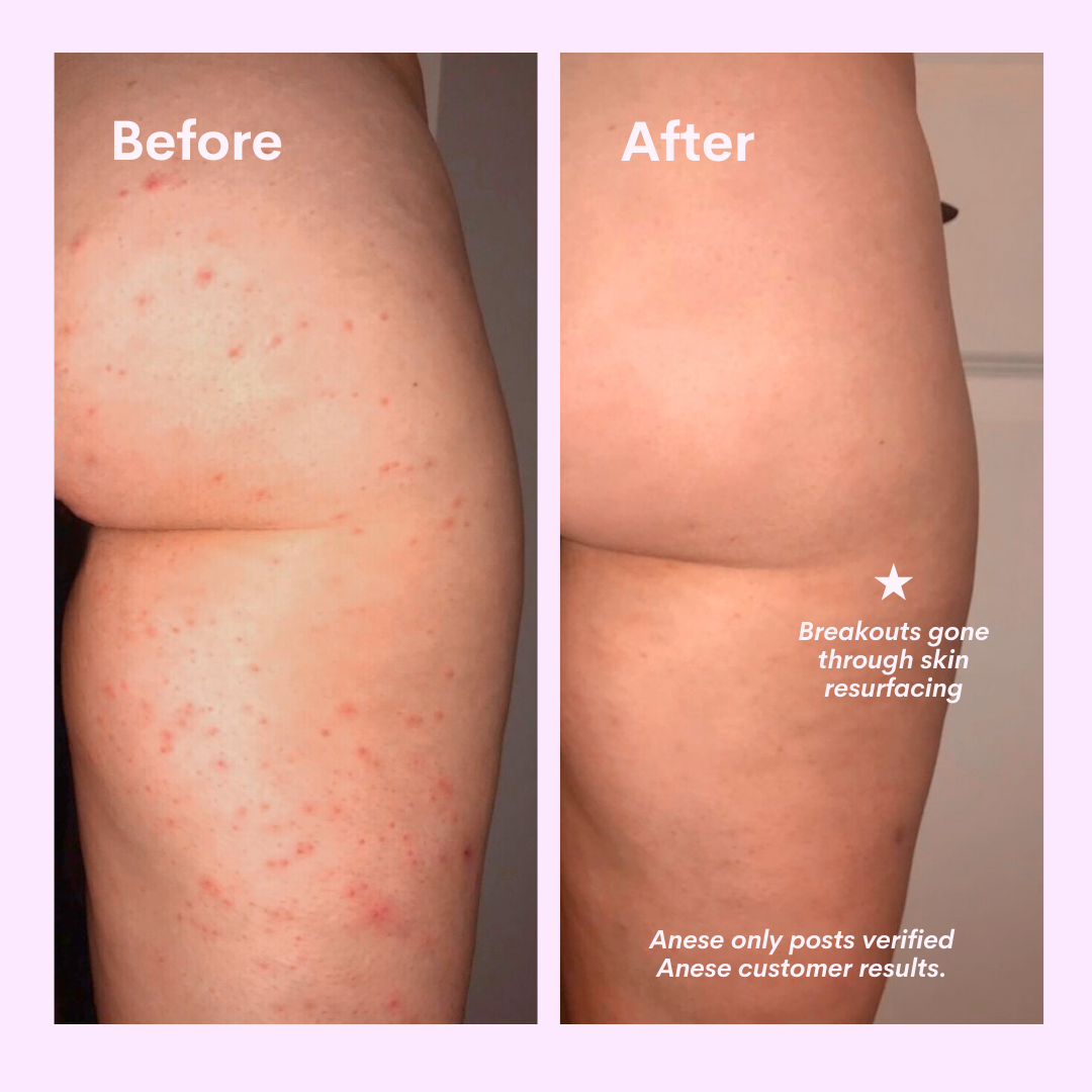 Body Acne Scrub - 90 Day